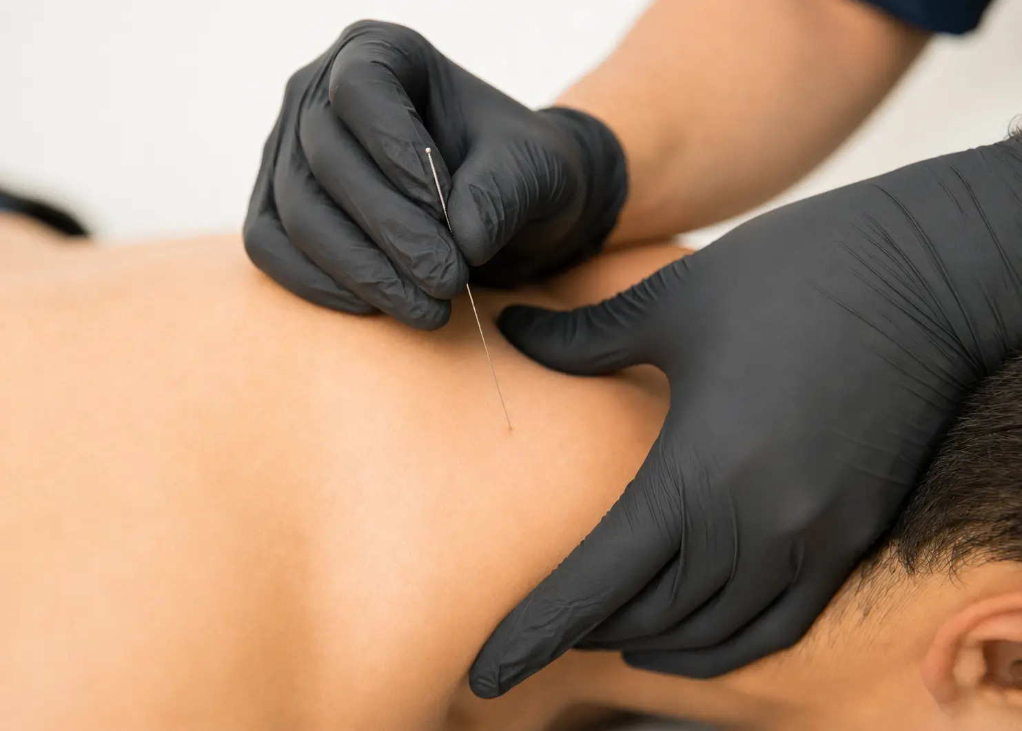 Trigger point dry needling treatment performed with black medical gloves